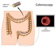 Colonoscopy procedure, eps8
