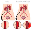 Abdominal aortic aneurysm, eps8