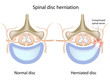 Spinal disc herniation, eps8