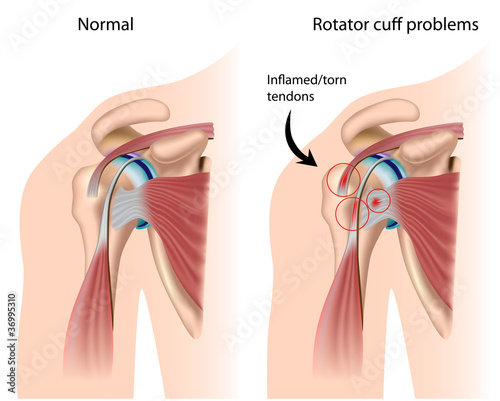 Vektor: Shoulder Impingement , eps8 Shoulder Impingement , eps8