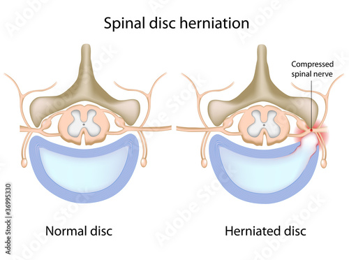 Vector: Spinal disc herniation, eps8 Spinal disc herniation, eps8