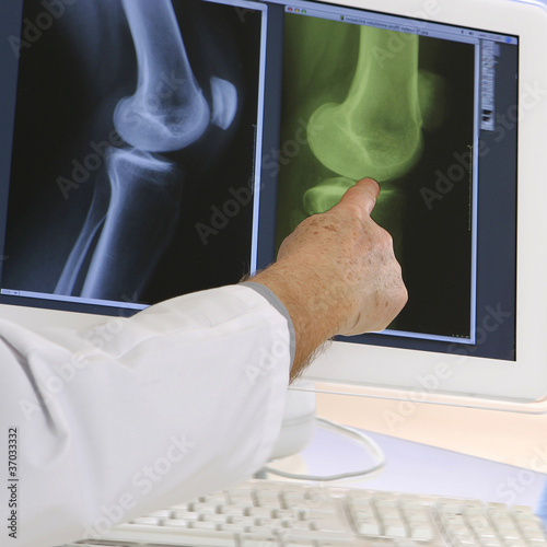 Photo: Cartilage du genou endommagé - Radio Cartilage du genou endommagé - Radio