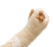 Photo: broken arm bone broken arm bone