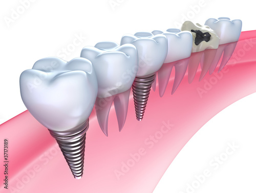 Illustration: Dental implants in the gum - Isolated on white Dental implants in the gum - Isolated on white