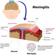 Meningitis, eps8