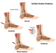 Achilles tendon problems, eps8