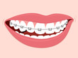 Braces Corrective Orthodontics Braces Corrective Orthodontics