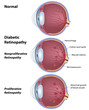 Diabetic retinopathy, eps8