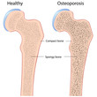 Osteoporosis of hip bone (femur), eps8