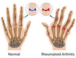 Rheumatoid arthritis of hand, eps8