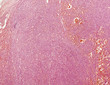 Microscope picture of Kaposi's sarcoma