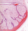 Fibroadenoma of breast
