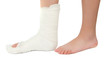 leg in a plaster cast leg in a plaster cast