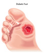 Piede diabetico
