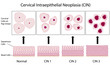 Cervical dysplasia stages and pap smear test, eps8