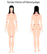 Tender points of Fibromyalgia, eps8