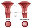 Cervical cancer, eps8