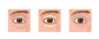 blepharoplasty