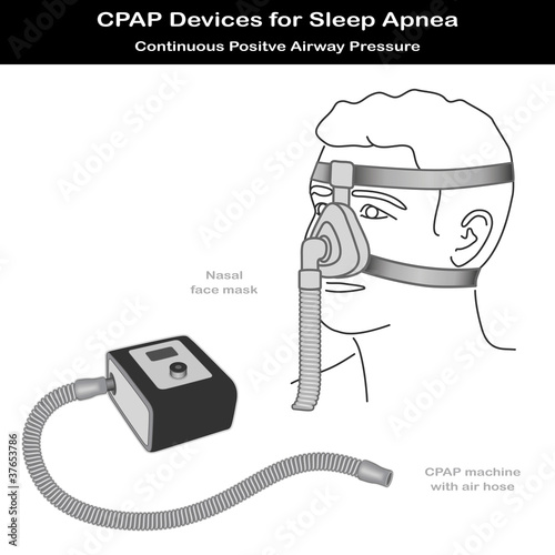 Vector: Sleep Apnea, CPAP Machine, Air Hose, Nose Face Mask Sleep Apnea, CPAP Machine, Air Hose, Nose Face Mask