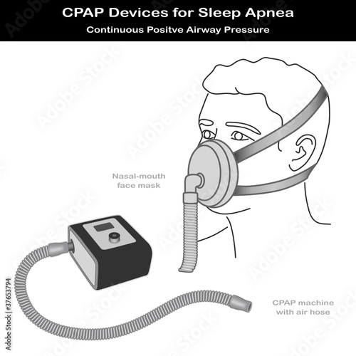Vektor: Sleep Apnea, CPAP Machine, Air Hose, Nasal-mouth Face Mask Sleep Apnea, CPAP Machine, Air Hose, Nasal-mouth Face Mask