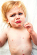 Chicken Pox Baby