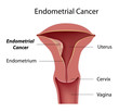 Endometrial cancer, eps8