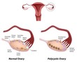 Normal ovary  and Polycystic ovary syndrome, eps8