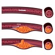 atherosclerosis plaque front and side view illustration