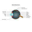 Retinal Detachment eps10 illustration