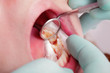 Photo: Dental, tooth cavity in closeup Dental, tooth cavity in closeup