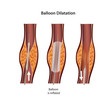 ballon dilatation eps vector illustration