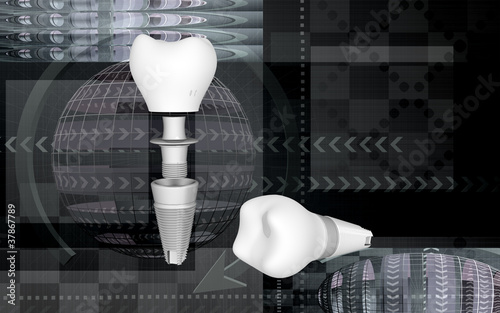 Illustration: Dental implant Dental implant