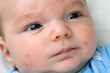 Baby Acne On Newborn