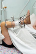 leg in Ilizarov's external fixator, Ilizarov's apparatus