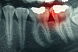 Foto: Dental xray, with red painful area Dental xray, with red painful area
