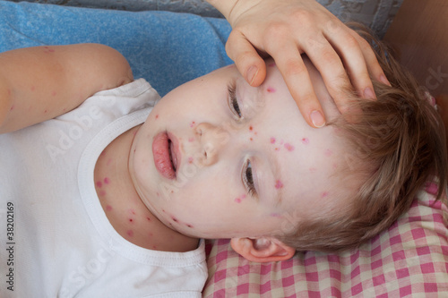 Photo: Close up boy with chickenpox Close up boy with chickenpox
