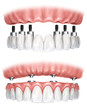 dental prostheses