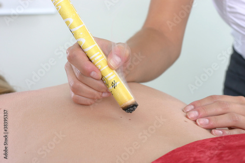 Photo: Moxibustion Moxibustion