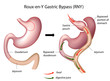Roux-en-Y Gastric Bypass (RNY) surgery, eps8
