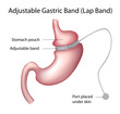 Gastric Band Weight Loss Surgery , eps8