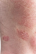 Psoriasis close-up