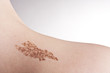 Birth mark and mole on the body