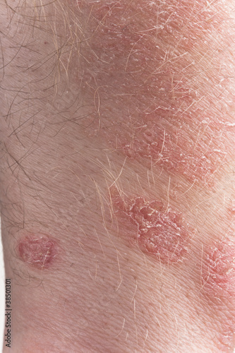 Photo: Psoriasis close-up Psoriasis close-up