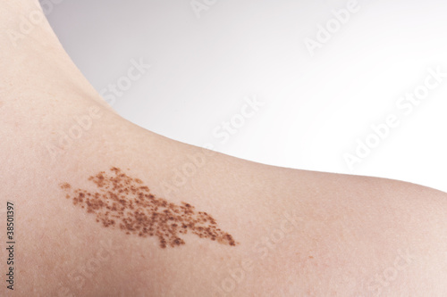 Photo: Birth mark and mole on the body Birth mark and mole on the body