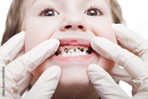 Photo: Caries teeth decay Caries teeth decay