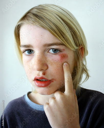 Photo: visage d'enfant contusionné visage d'enfant contusionné