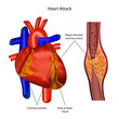coronary artery heart attack illustration