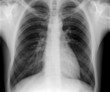 Photo: X-ray of human chest X-ray of human chest