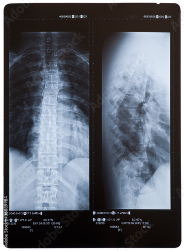 Photo: Back X-ray showing scoliosis (curvature). 2 views. Female. Back X-ray showing scoliosis (curvature). 2 views. Female.