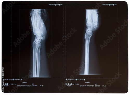 Photo: X-ray of the wrists from the side. Female. X-ray of the wrists from the side. Female.